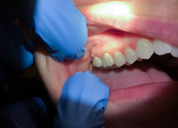 Best Emergency Dental Extractions in New Holland, PA